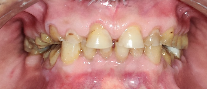 Before